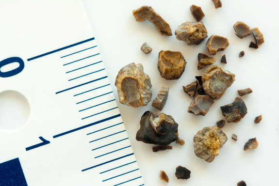 What are Kidney Stones?