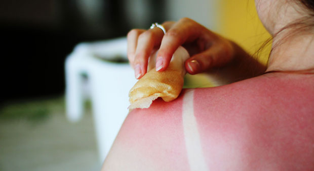 Sunburn Treatment and Relief the Right Way