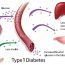Type 1 Diabetes Causes