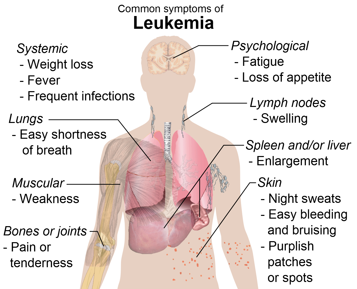 Signs and Symptoms of Leukemia