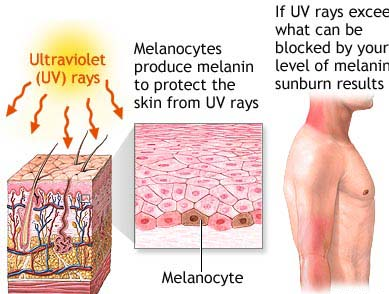 What Causes Sunburn?