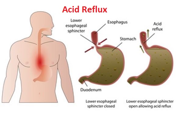 Causes of Acid Reflux: What Causes Acid Reflux?