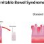 Irritable Bowel Syndrome Causes