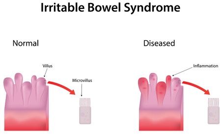 14 Causes of Irritable Bowel Syndrome (IBS)