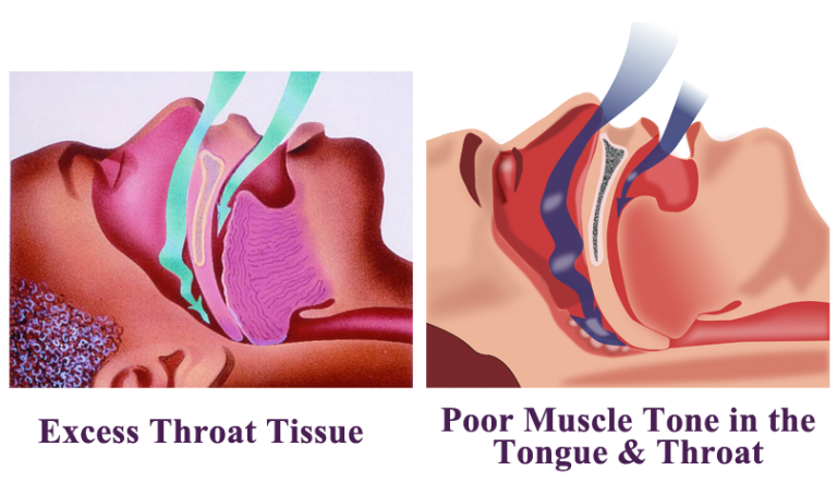 What Causes Sleep Apnea Healthnormal