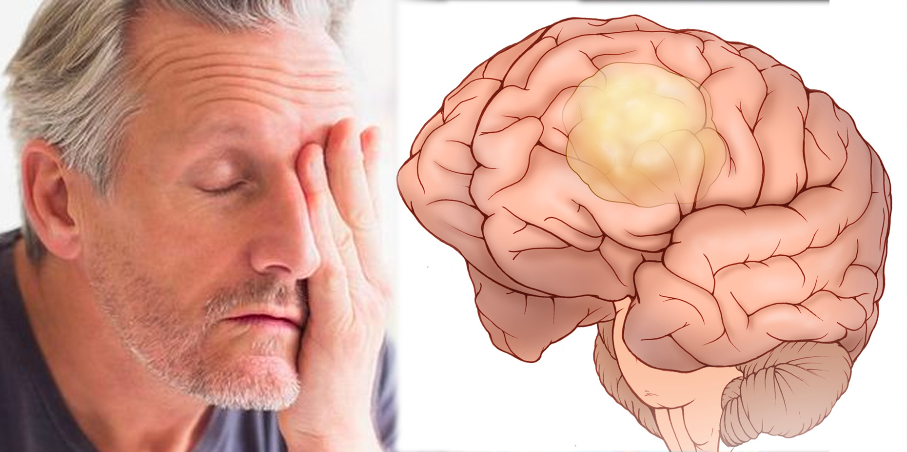 9 Warning Signs & Symptoms Of Brain Tumor