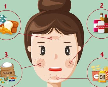 Foods That Cause Acne