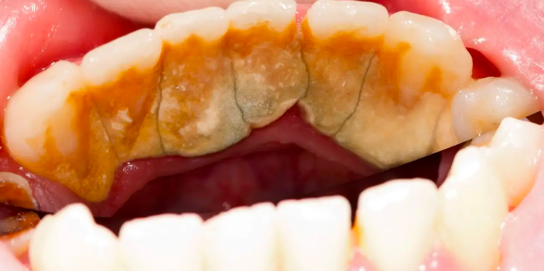 How to Remove Plaque & Tartar Buildup from Your Teeth – 9 Ways