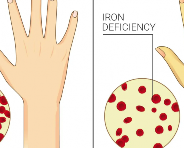 Iron Deficiency Symptoms