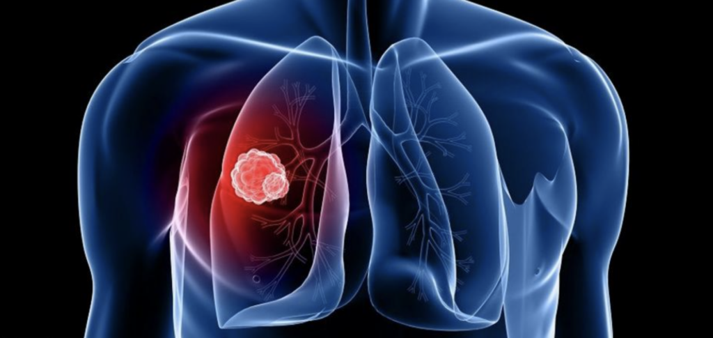 lung-cancer-types-causes-symptoms-treatment-and-more