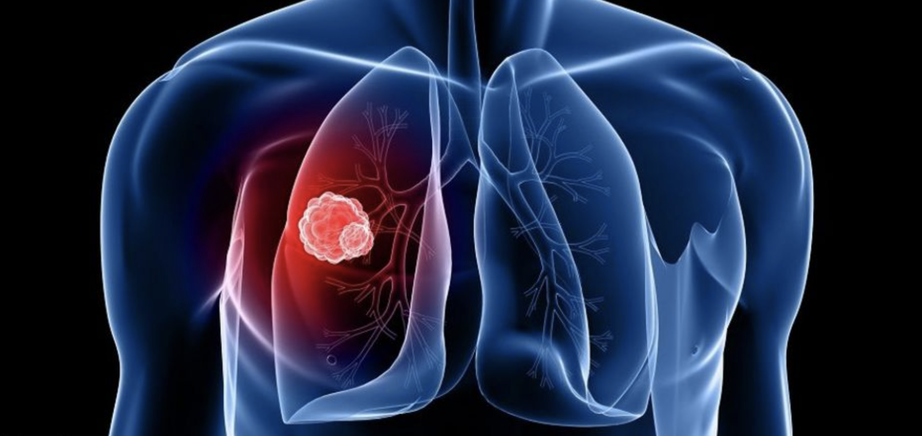 Everything You Need To Know About Lung Cancer