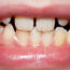 Malocclusion of Teeth