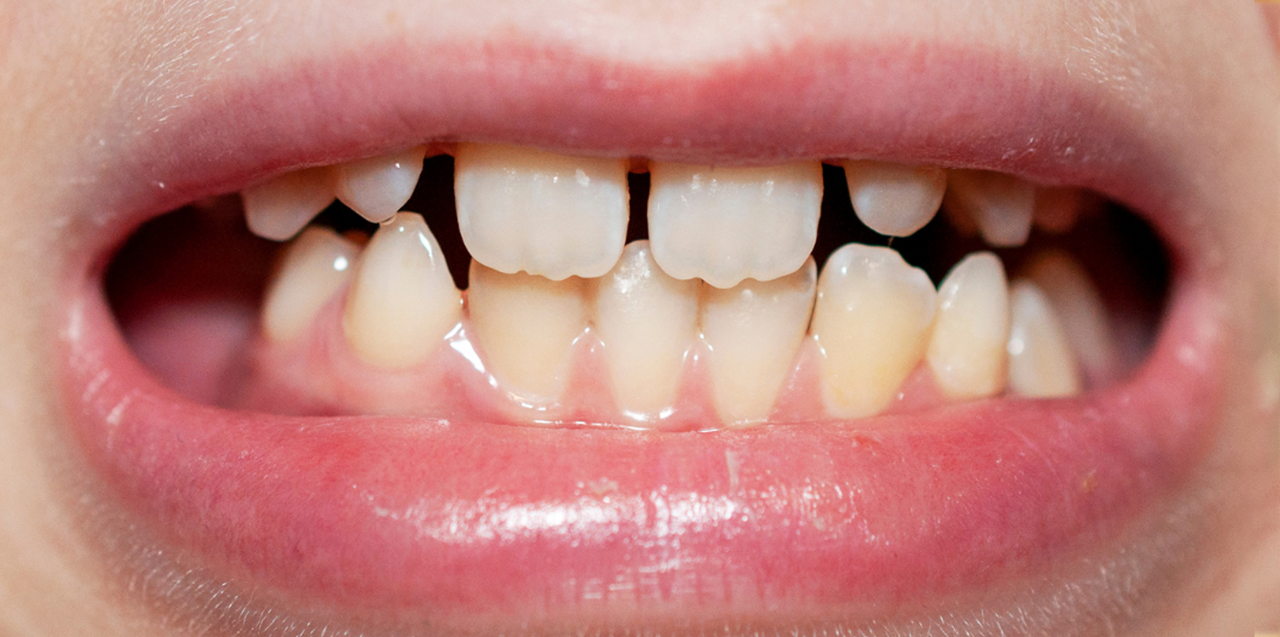 Malocclusion of Teeth: Classification, Causes, Treatment, and More