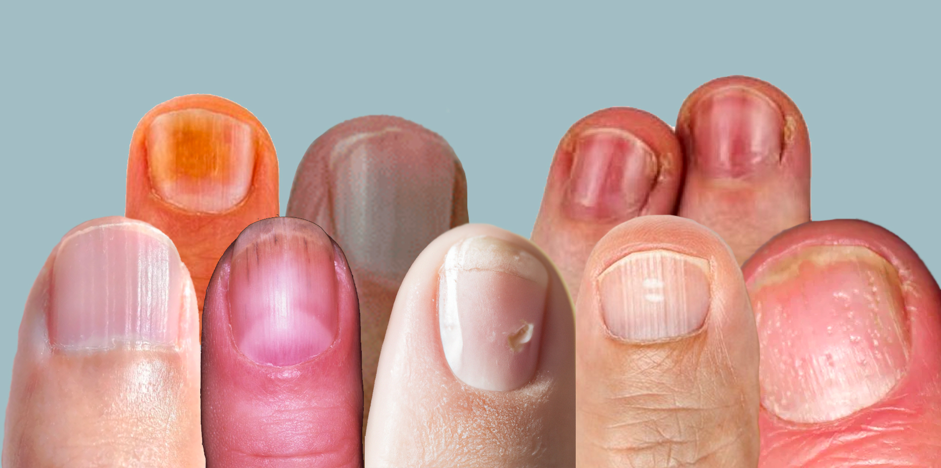 Nail Health: Problems, Causes, and Treatment