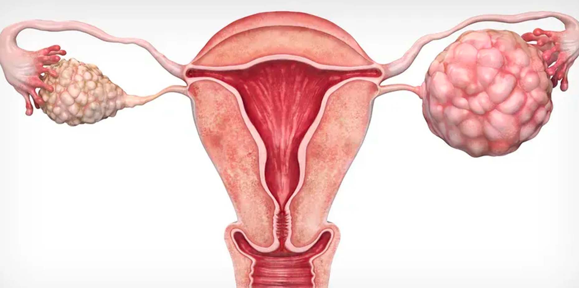 Ovarian Cancer: Types, Risk factors, Symptoms, and Treatment
