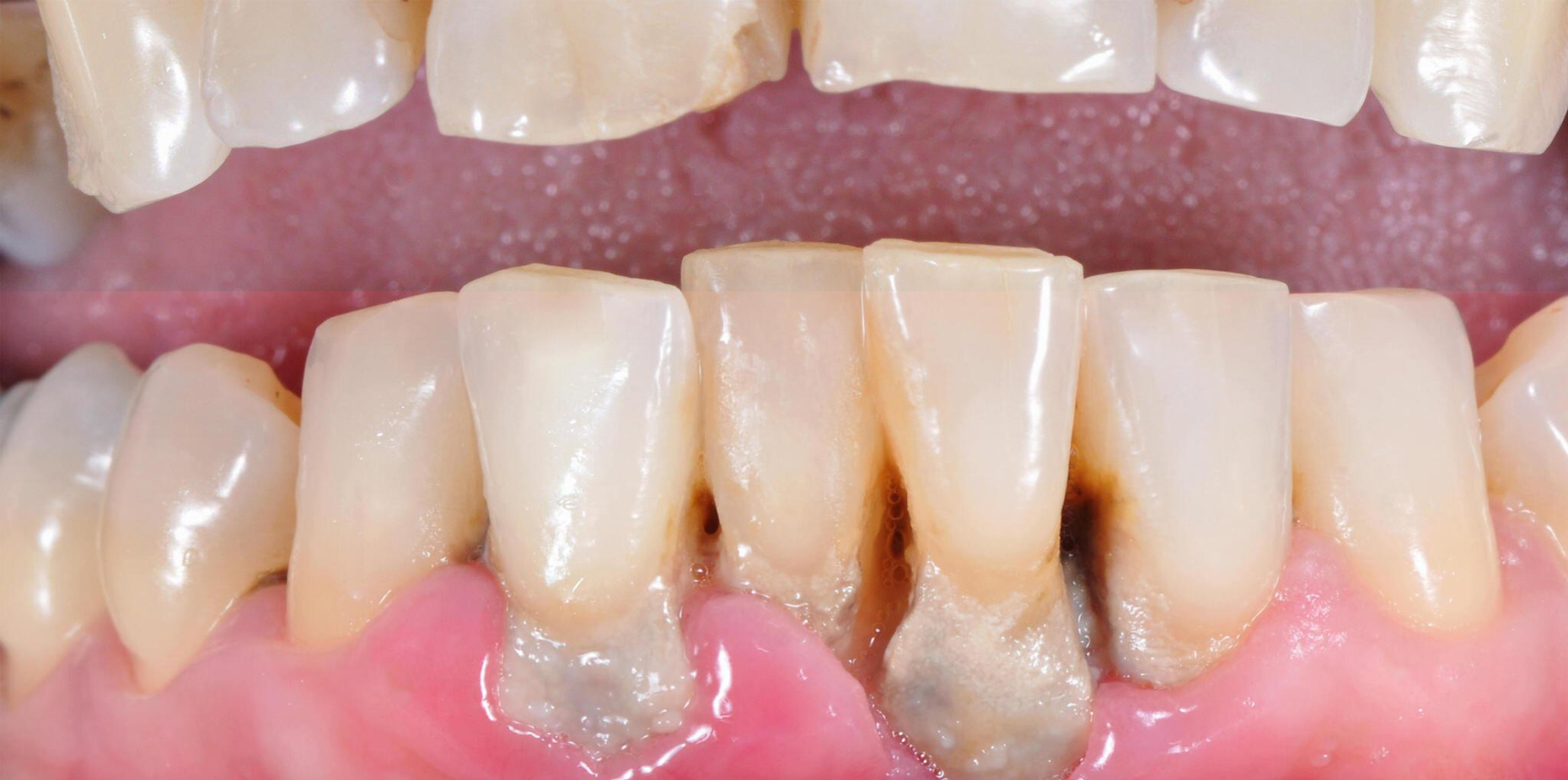 Periodontitis: Types, Stages, Symptoms, Causes, and Treatment