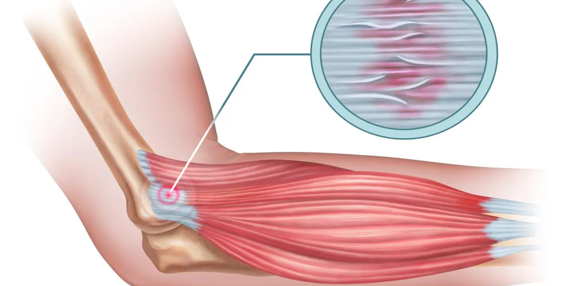 Tendinopathy: Symtoms, Causes, Treatments, and More