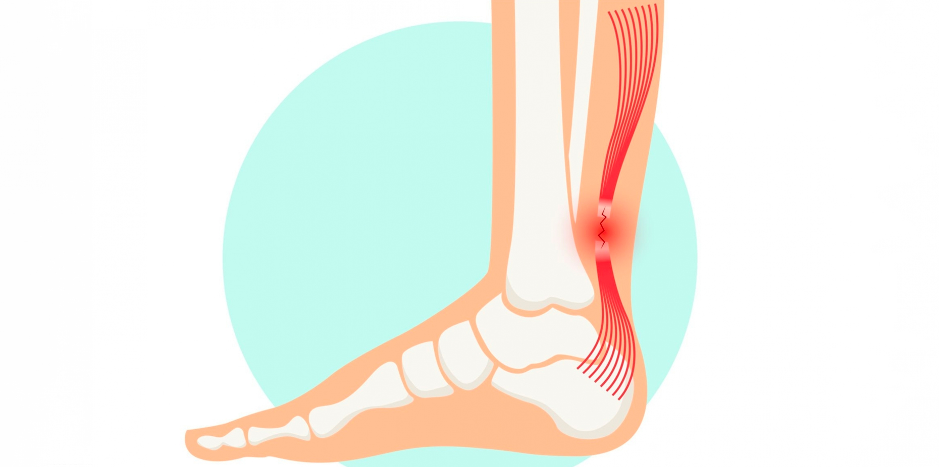 Tendon Conditions: Types, Causes, Treatments and More