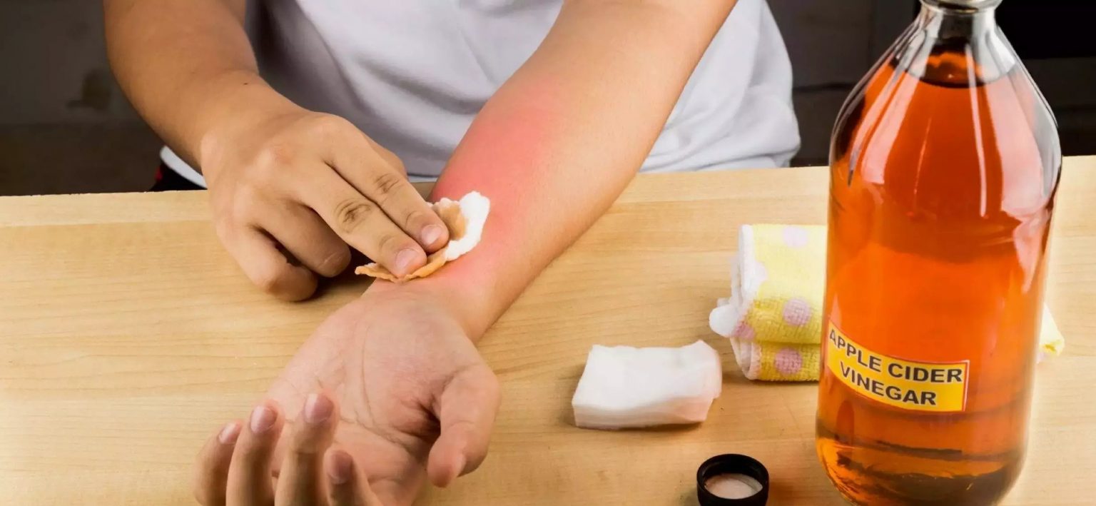Vinegar for sunburn Is Vinegar good for sunburn relief? HealthNormal