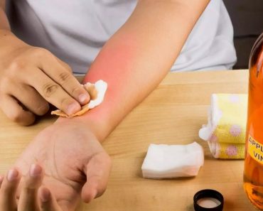 Vinegar for Sunburn