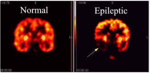 Epilepsy Diagnosis