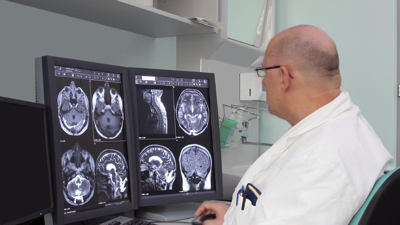 MS Diagnosis Multiple Sclerosis Diagnosis and Testing