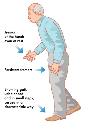 Parkinsons Symptoms