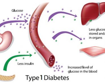 Type 1 Diabetes Cure and Treatment the right way - Health Normal