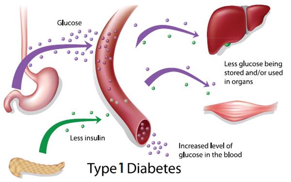 Type 1 Diabetes Causes