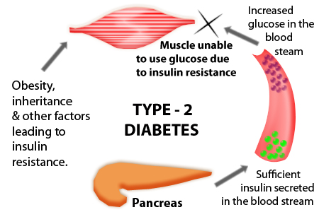Type 2 Diabetes Causes