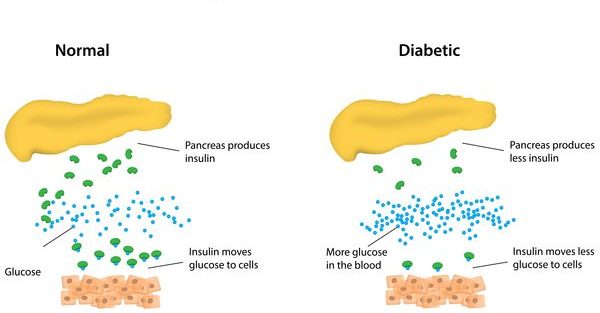 What is Type 1 Diabetes?