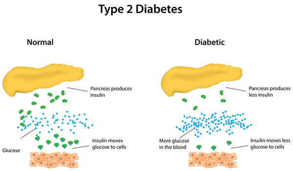 What is Type 1 Diabetes?