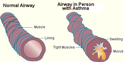 Asthma Causes