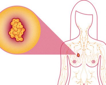 Breast Cancer