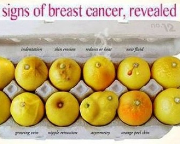 Breast Cancer Symptoms