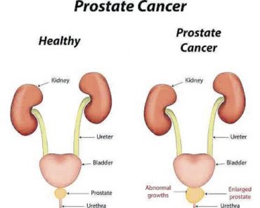 Prostate Cancer