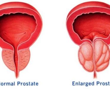 Prostate Cancer Causes