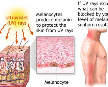 Sunburn Causes