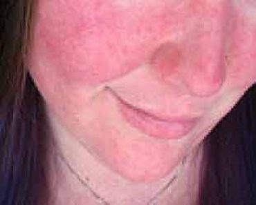 Sunburn Symptoms