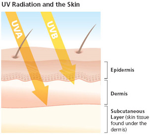 Sunburn