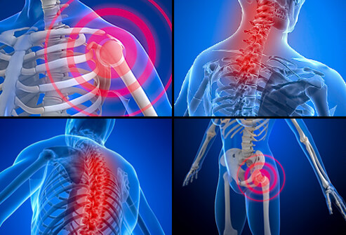 What is Fibromyalgia?