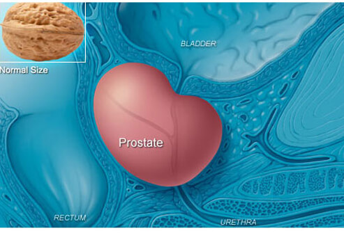 What is Prostate Cancer