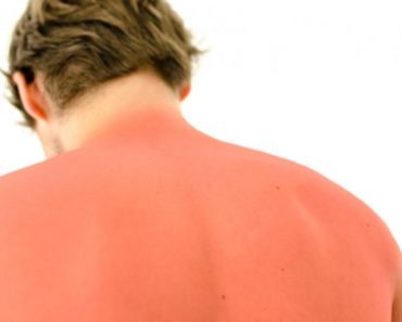 What is Sunburn?