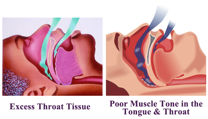 Sleep Apnea Causes