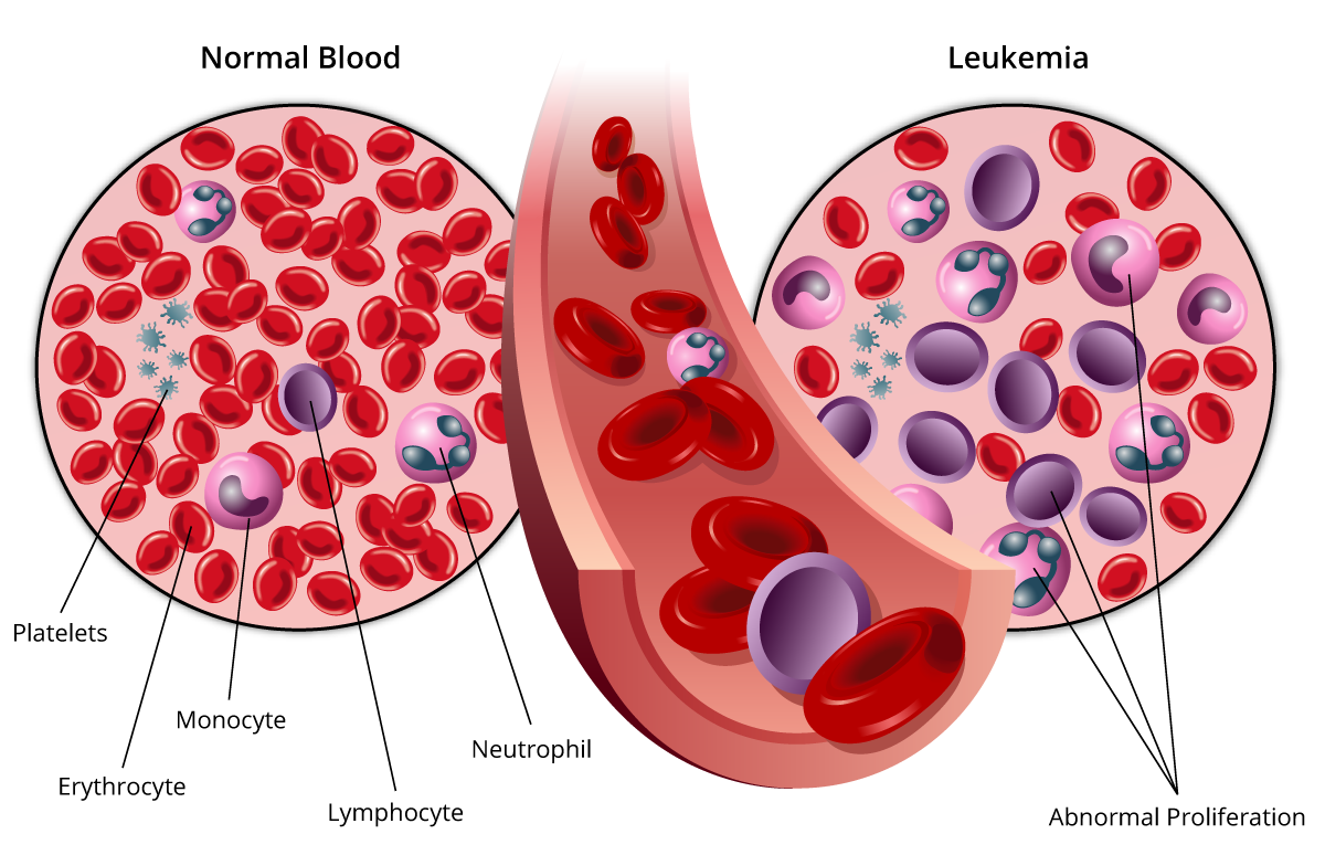 Leukemia Center