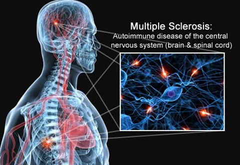 Multiple Sclerosis Center