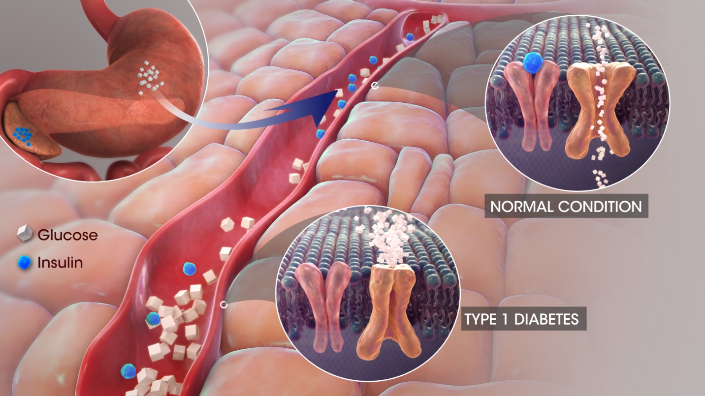 Type 1 Diabetes Center
