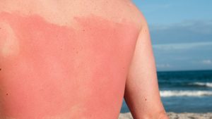 Sunburn Center